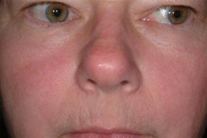 If I Have Rosacea Is It Okay To Get A Facial? By Beauty Salon Taringa - Call Us On 07 3871 0477