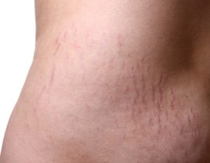 How To Do Away With Stretch Marks